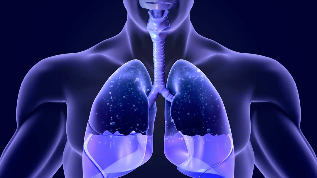 Derrame Pleural Causas Sintomas E Tratamentos Icator